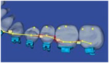 Braces Archwire Placement on 3-D Orthodontic Scan of Teeth